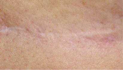 Complication cicatrices post-opératoires