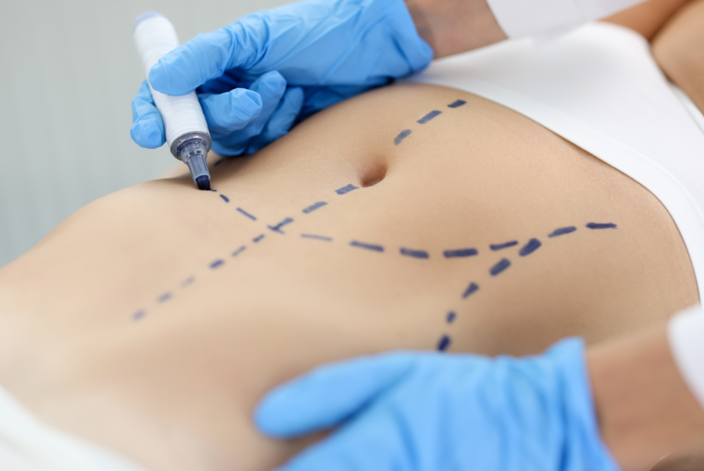 cicatrice après abdominoplastie