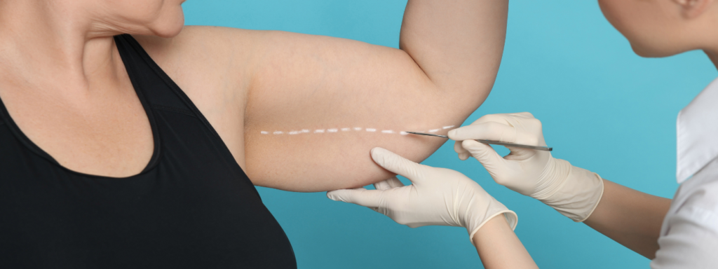 brachioplastie